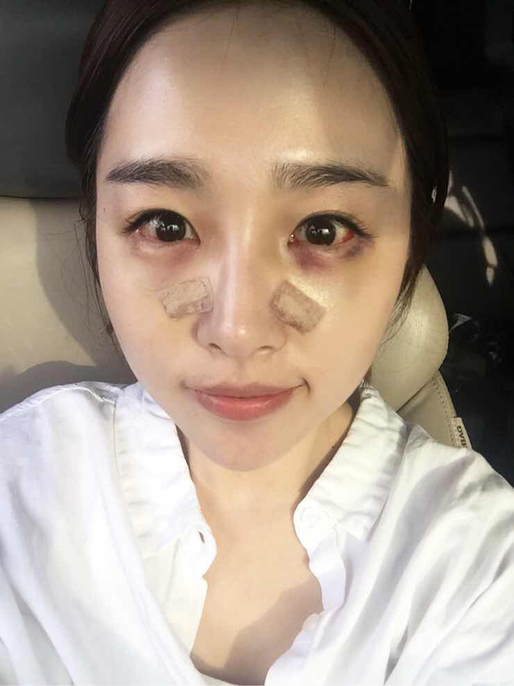 黑眼圈手术多少钱,你们有和我一样的烦恼吗?