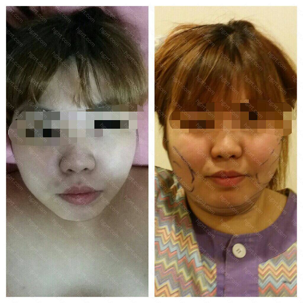 全切去脂肪 吸脂去双下巴手术案例 成功告别大脸 双下巴吸脂 整形经历 整容通 全切去脂肪 吸脂去双下巴手术案例 成功告别大脸 双下巴吸脂 整形经历 整容通