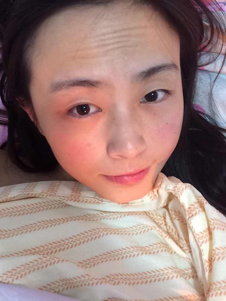 注射去抬头纹和手术去抬头纹那个效果更好?这照片是经过处理的,本人的很严重!