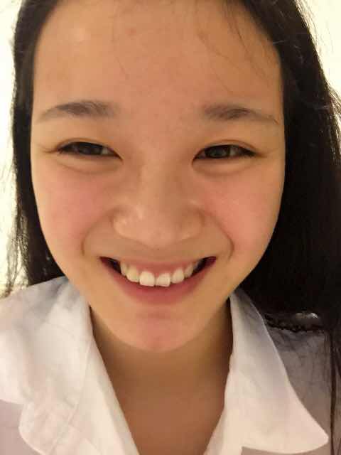 发际线过高可以种植美人尖调整吗?笑起来很丑,有时笑起来就跟哭似的,笑的时候颧骨那肉肉的,变得很高,显得眼睛很小,而且嘴角也不上扬,鼻翼两边的线也很深,求问专家要怎么整才有好看的笑容