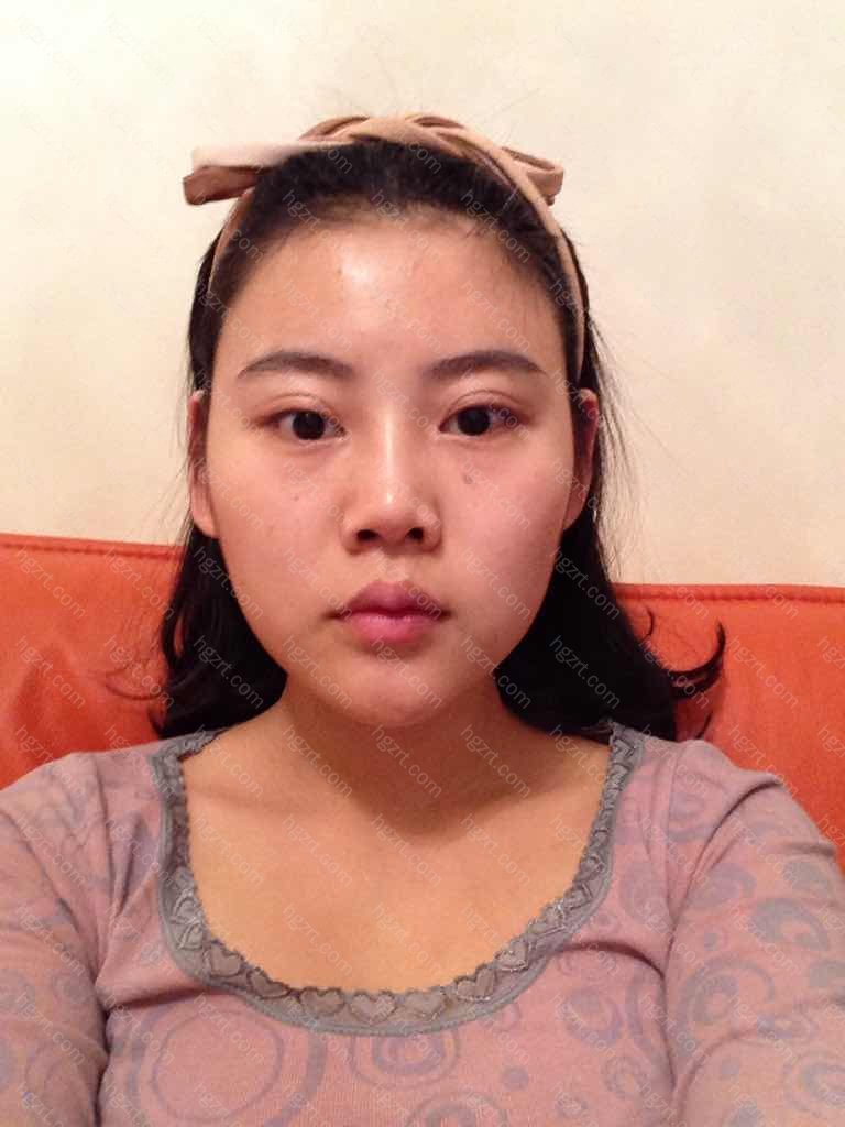 隆鼻失败修复怎么做 鼻子看起来不自然 还有眼睛这里 是不是割的太宽了 Vline问答 整形问答 整容通 隆鼻失败修复怎么做 鼻子看起来不自然 还有眼睛这里 是不是割的太宽了 Vline问答 整形问答 整容通