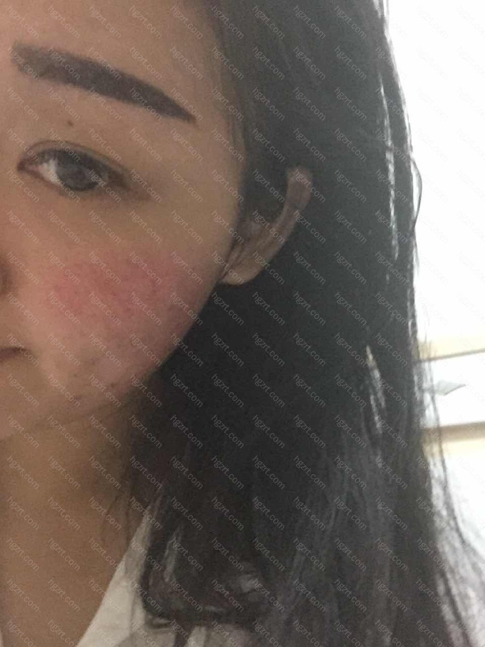 海绵微针是什么 刚做完海绵微针皮肤好红几天后开始脱皮可以彻底解决痘痘痘印的问题和毛孔粗大痘坑需要慢慢治疗有一定效果加上微针会更好 整形 广告 时尚八卦 整容通 海绵微针是什么 刚做完海绵微针皮肤好红几天后开始脱皮可以彻底解决痘痘痘印的问题和毛孔粗大痘坑需要慢慢治疗有一定效果加上微针会更好 整形 广告 时尚八卦 整容通