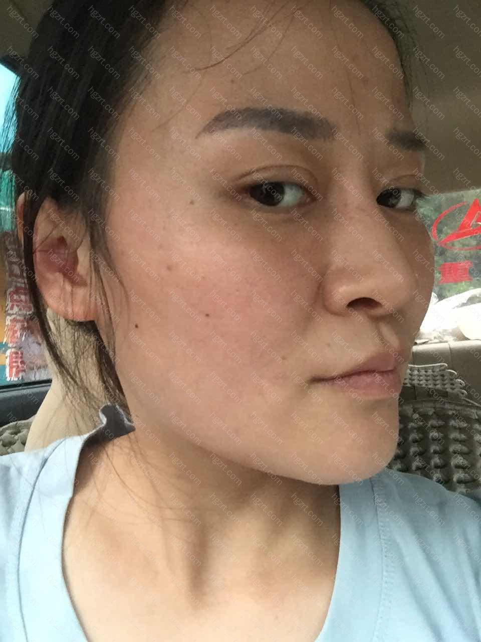 鼻子做了膨体隆鼻两个月了弯曲还歪去厉害 鼻梁上还凹凸不平 是失败了吗 现在可以重做妈 膨体隆鼻模拟 整形模拟 整容通 鼻子做了膨体隆鼻两个月了弯曲还歪去厉害 鼻梁上还凹凸不平 是失败了吗 现在可以重做妈 膨体隆鼻模拟 整形模拟 整容通