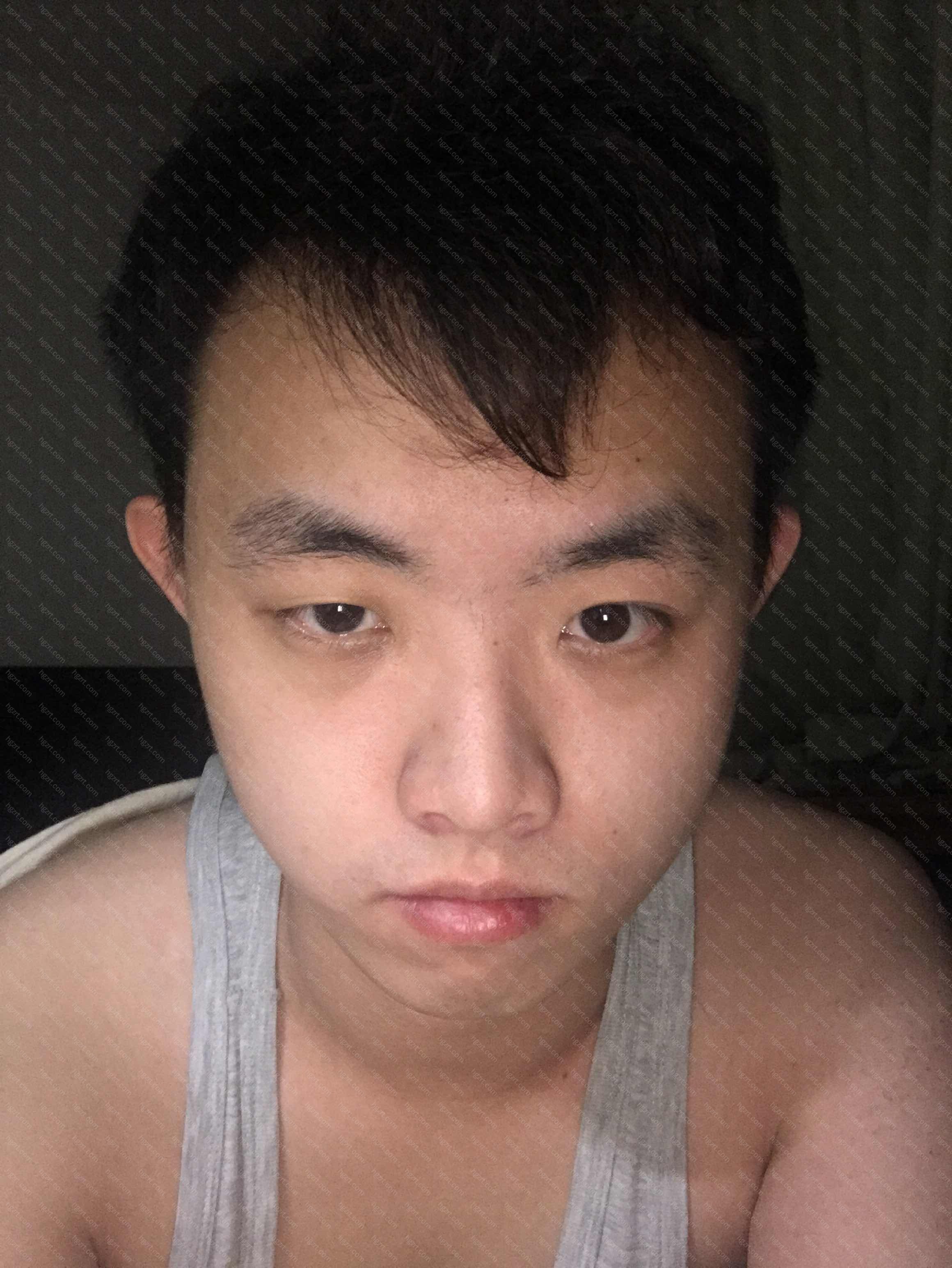 鼻孔外露怎么整形 就是鼻子漏孔想要个有鼻尖的不漏的鼻子 假体隆鼻模拟 整形模拟 整容通 鼻孔外露怎么整形 就是鼻子漏孔想要个有鼻尖的不漏的鼻子 假体隆鼻模拟 整形模拟 整容通