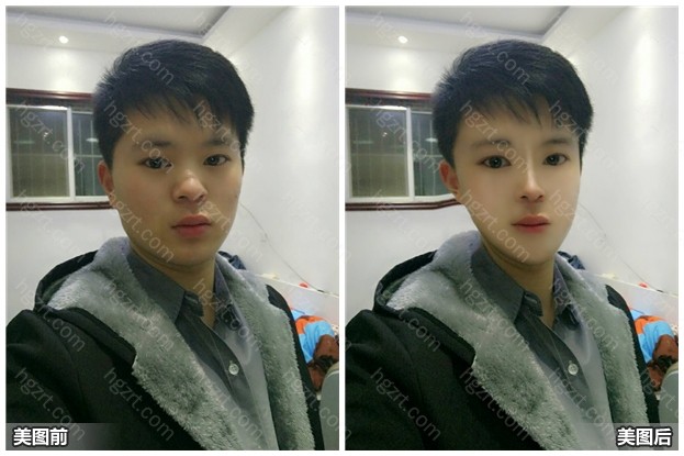 脸型整形前后对比 不管男的女的 应该没有喜欢大脸的吧 哈哈哈 Vline模拟 整形模拟 整容通