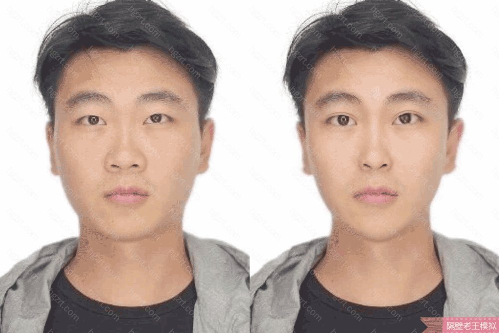 双眼皮和鼻综合效果假想图 让你变成气质男神 韩式双眼皮模拟 整形模拟 整容通
