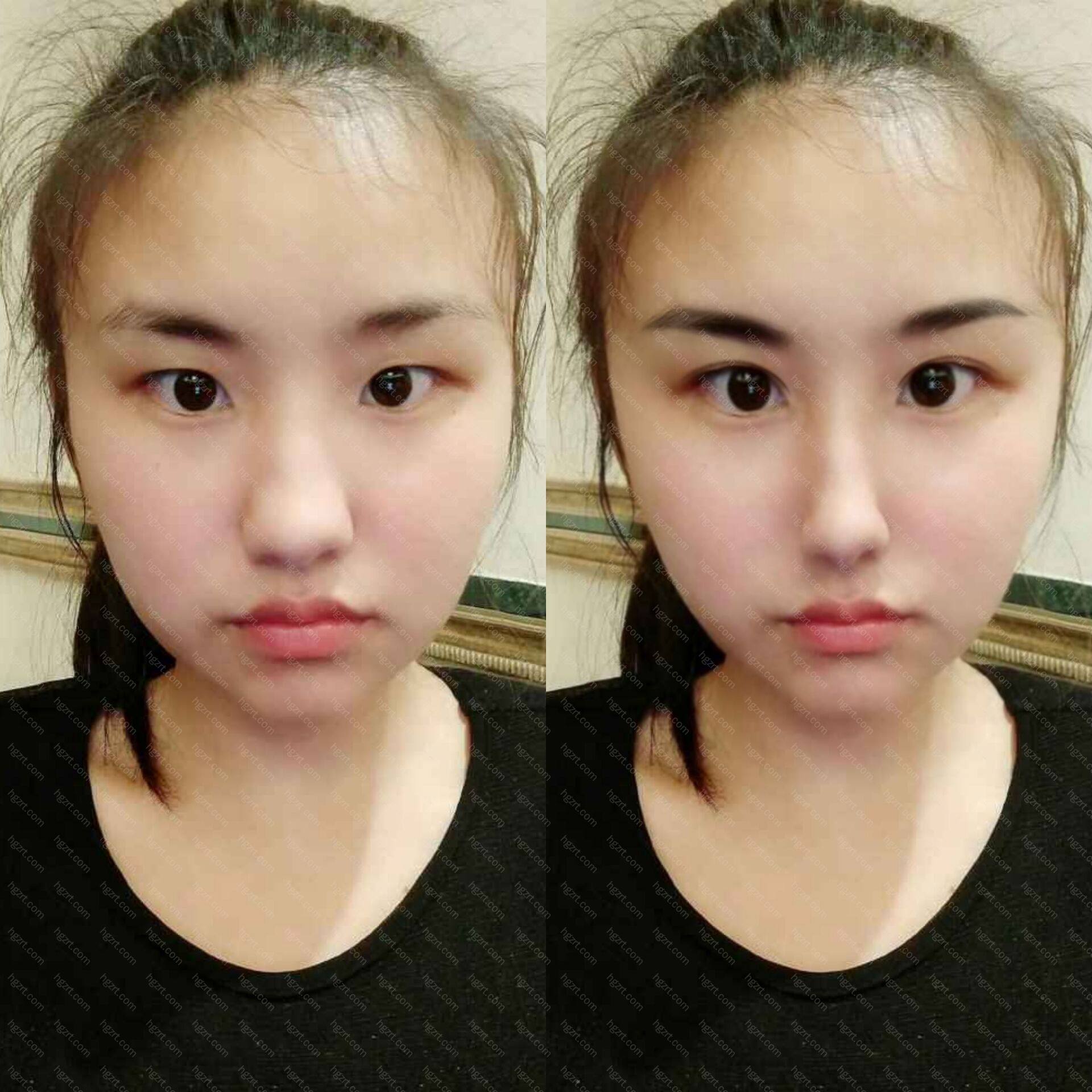 预想开眼角 鼻综合模拟效果图 开外眼角模拟 整形模拟 整容通 预想开眼角 鼻综合模拟效果图 开外眼角模拟 整形模拟 整容通