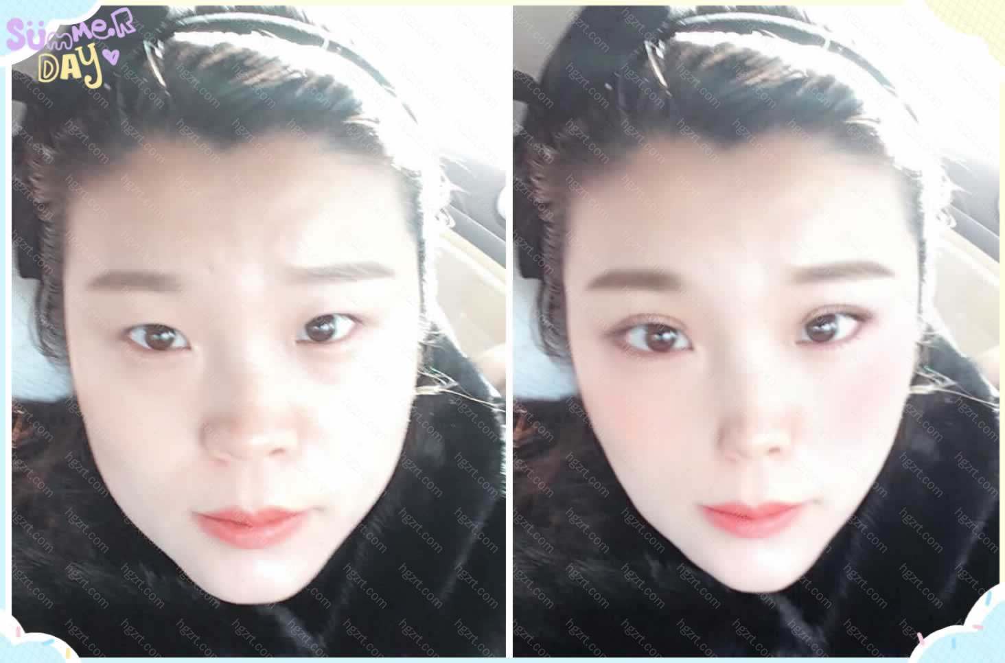 设计瘦脸针效果前后对比图 瘦体蛋白瘦脸针模拟 整形模拟 整容通