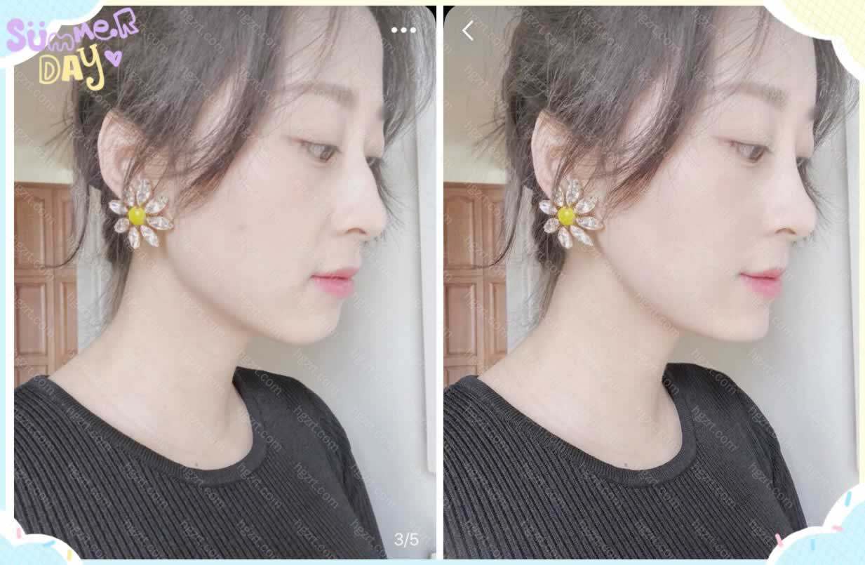 预想驼峰鼻矫正效果图 驼峰鼻手术模拟 整形模拟 整容通app