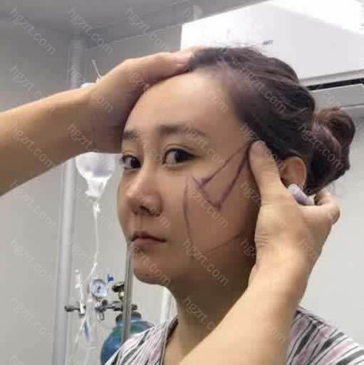 今天是刚做完面部线雕的first天
