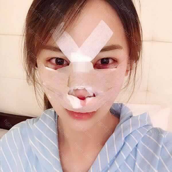 做鼻部修复手术建议去韩国做 一定要找正规的整形医院 整容通