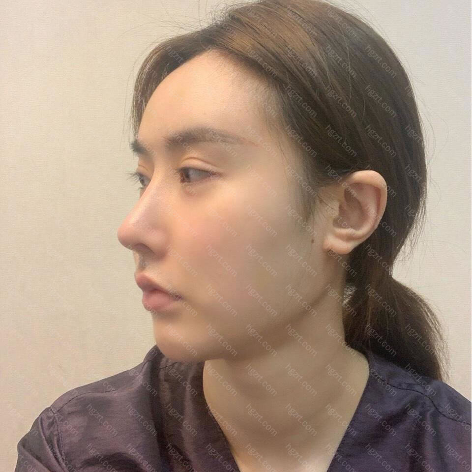 到韩国整形医院颧骨颧弓整形术后我成功告别大饼脸 自拍再不用p图 整容通