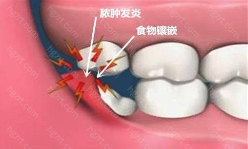 在南京拔智齿哪家好？拔一颗智齿需要多少钱？小编整理南京拔牙技术好又便宜的三家医院