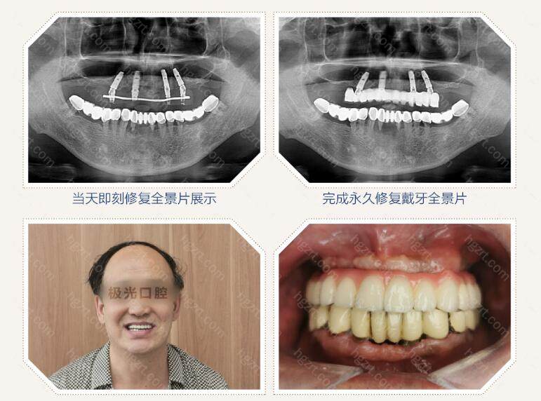 成都极光口腔做种植牙的技术靠谱吗