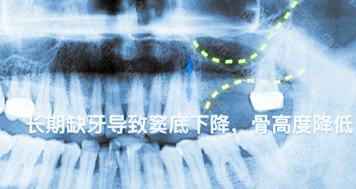 如果不具备即刻种植条件却强行种牙