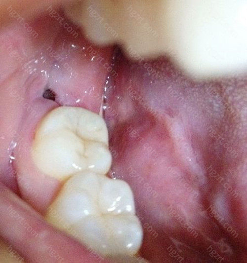 再过一段时间，结缔组织和上皮组织就会替代肉芽组织，这个过程大概在20天左右就能完成，一个多月之后，成熟的牙槽骨组织基本已经逐渐填平这个牙洞，整体开始变得平整。