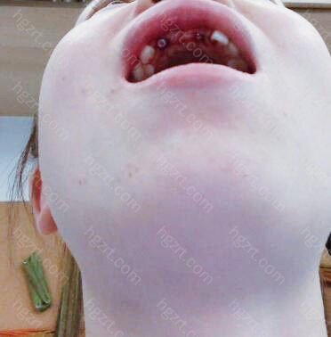 牙槽骨被吸收等问题都可以将概率减少到很低很低！这样精细的操作技术在其他种植体方面是不能实现的