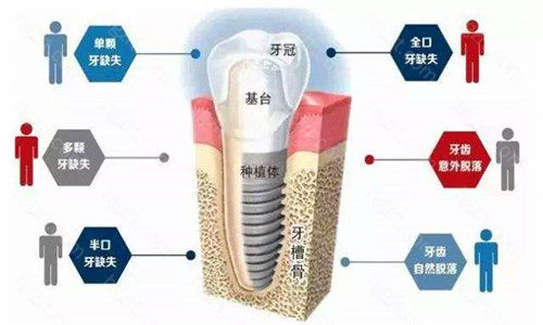 种植牙分开种植体、基台、牙冠其中重要的就是种植体；这两款种植体是目前使用率较高的种植体