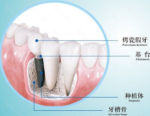 那么这么多种植体材料该如何人选择呢？种植牙钛合金好还是纯钛好？一级钛到5级钛的区别是啥？就让我们一起来了解下