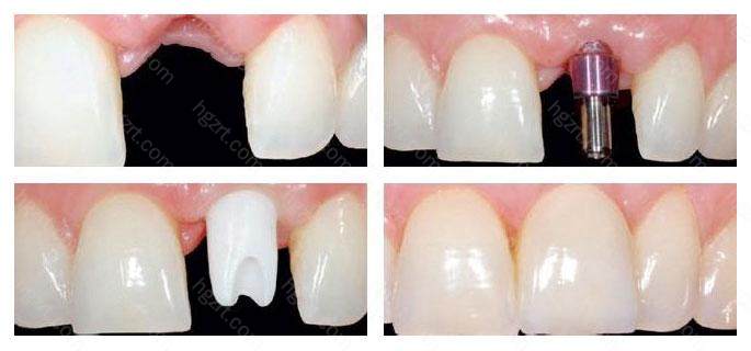 就是在拔除牙齿之后 就是在拔除牙齿之后