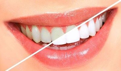 目前这两款是在口腔医院比较常见的牙齿美白方式