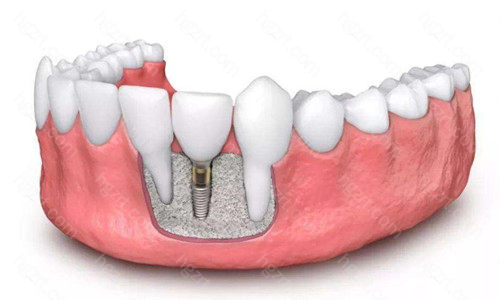 本文主要介绍即刻种植牙和延期种植牙的区别