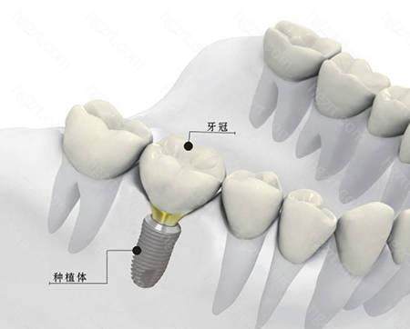 延期种植是指患者在拔牙经过一段时间后（3~4个月)待拔牙创伤已完全愈合