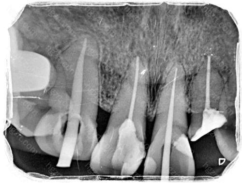 很多患者关心做过根管的牙能用几年？正常情况下