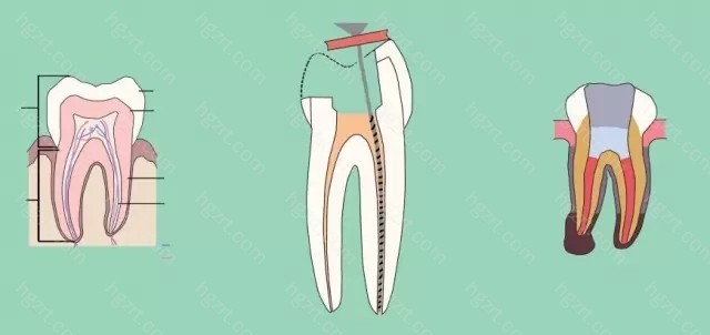 有个比较热门的话题就是说“根管治疗千万不要做牙冠”