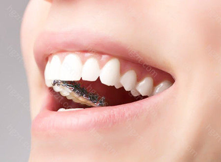 舌侧矫正是将牙套戴在了牙齿内侧