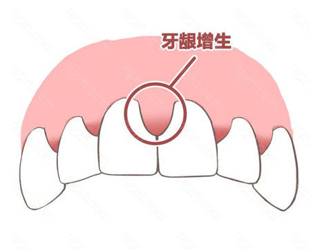 大家经常听到牙周炎、牙龈炎