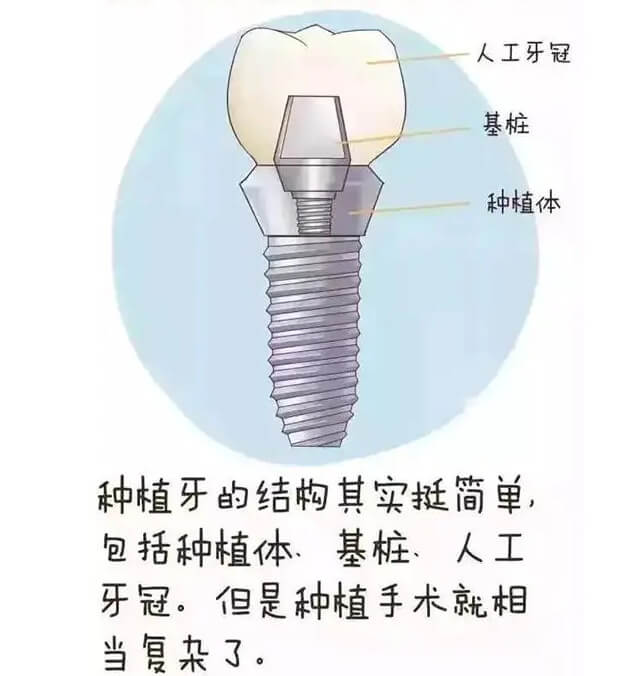 种植牙介绍图平