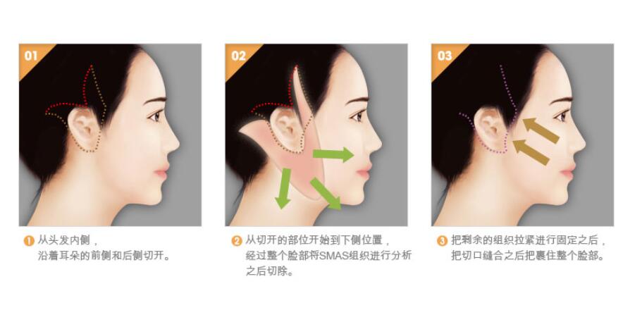 北京加减美V拉皮需要多少钱