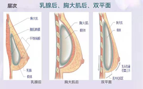 隆胸手术