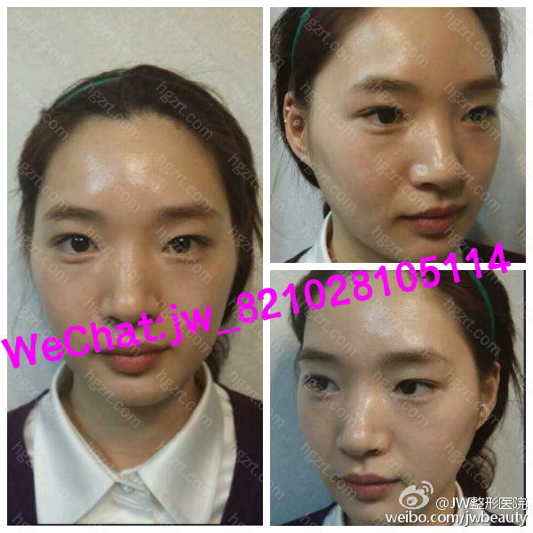 韩国jw整形外科鼻骨宽想隆鼻是不是非要截骨内推 韩国宽鼻骨截骨内推手术 鼻整形手术前 宽鼻骨 有棘突 鼻整形手术后 鼻子变秀气 当然这个模特还做了眼睛和颧骨缩小 整体效果很理想 从土气到时尚 就在 假体隆鼻问答 整形问答 整容通 韩国jw整形外科鼻骨宽想隆鼻是不是非要截骨内推 韩国宽鼻骨截骨内推手术 鼻整形手术前 宽鼻骨 有棘突 鼻整形手术后 鼻子变秀气 当然这个模特还做了眼睛和颧骨缩小 整体效果很理想 从土气到时尚 就在 假体隆鼻问答 整形问答 整容通