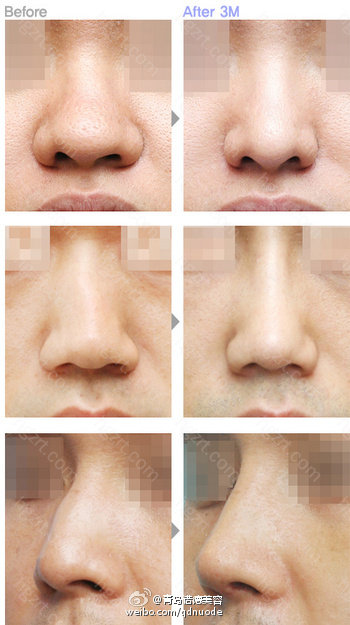 宽鼻的改善方法 鼻梁宽的情况若单纯垫高鼻梁会使鼻部与脸部不协调 给人男性般强悍的感觉 因此手术前确定与脸部相协调的鼻梁厚度与鼻部线条是非常重要的 诺德的 宽鼻骨修整术沿着鼻骨两侧纵向部分切除鼻骨 从而 整容通