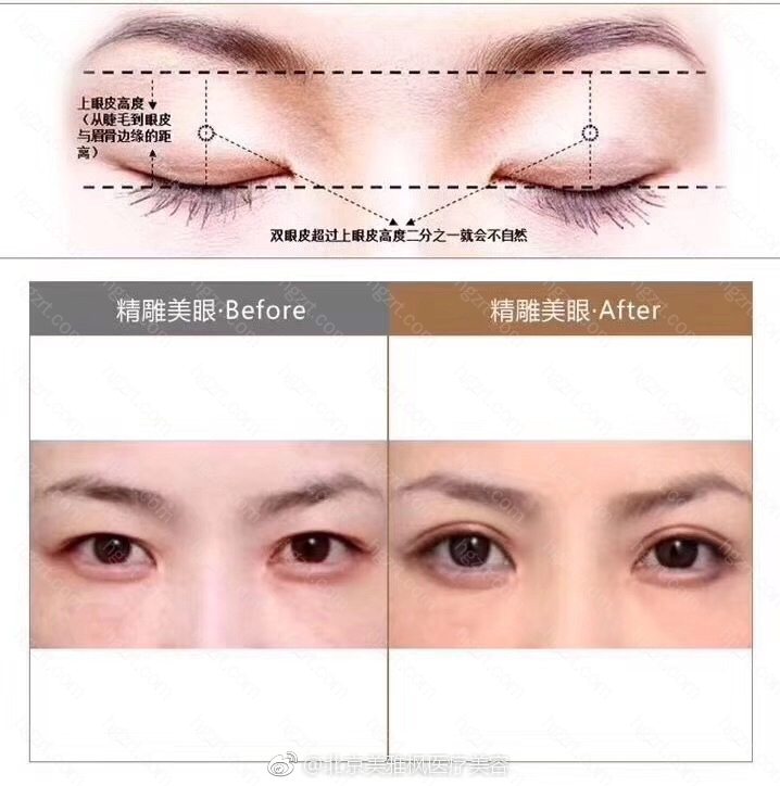 双眼皮宽度怎么确定 必须要根据脸型 眉弓至上眼皮的宽窄 眼窝的深浅 上睑厚薄等因素来确定 这便是美学设计的基础测量标准 同时平衡个人气质及需求打造灵韵美 目 整形医院 时尚八卦 整容通
